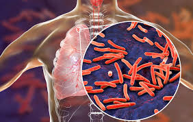 Tuberculosis Management